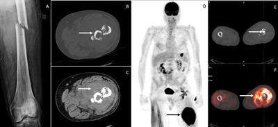 Pathological fracture due to primary bone lymphoma in a patient with a history of prostate cancer: A case report and review of literature